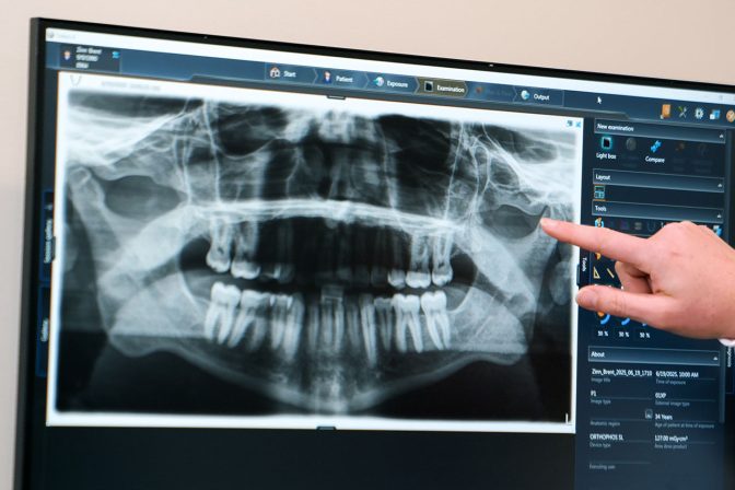 All-on-X Dental Implant Dentist in Kentwood MI