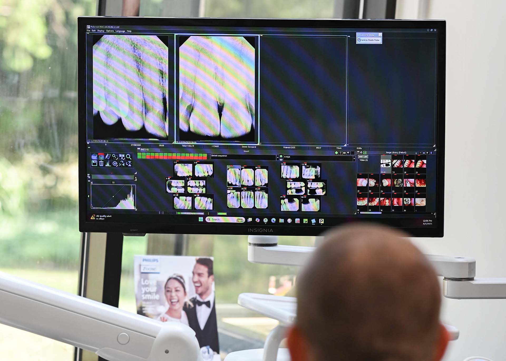 PRF Bone Grafting Kentwood MI